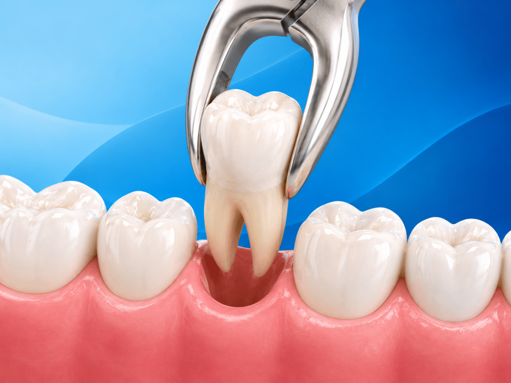 Dental Abscess Dental Abscess