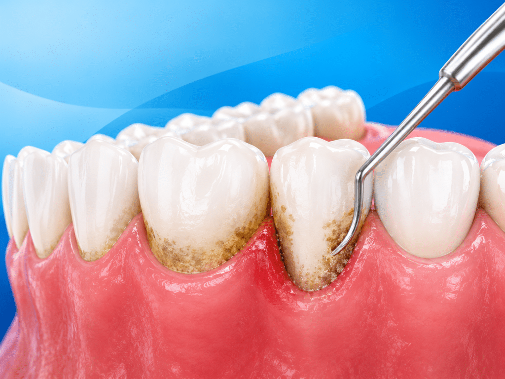 Gum Disease Treatment