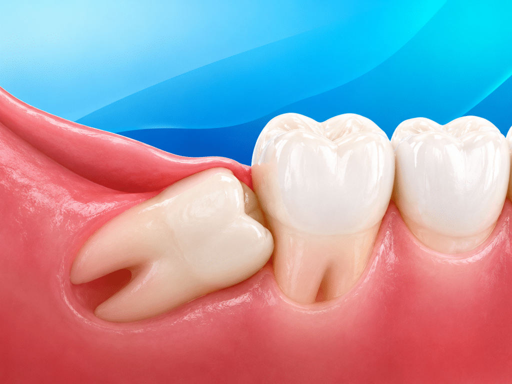 Wisdom Teeth Removal